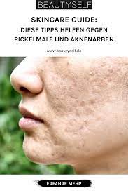 Gesunde ernährung und ausreichend schlaf „von der schokolade bekommst du nur noch mehr pickel. solche aussagen sind für das kind eher verletzend als hilfreich. Wir Haben Fur Dich 3 Tipps Gegen Pickelmale Und Aknenarben Beautyself Aknenarben Akne Pickel
