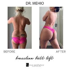 Offering the most affordable plastic surgery procedures. Mia Aesthetics Beautiful Bbl By Drmehio Mia Miaaesthetics Miababe Booty Beautiful Curves Hips Before After Beforeandafter Plasticsurgery Plasticsurgeon Dreambody Bodygoals Goals Surgerywishpic Wishpic Mehiodoll Facebook