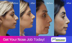 We did not find results for: How Much Is A Nose Job Rhinoplasty Jet Medical Tourism In Mexico