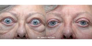 The thyroid eye disease book will fill a void for much sought after information on this condition unique to thousands of graves' patients worldwide. Medical And Surgical Treatment For Thyroid Eye Disease