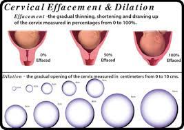 Are You Dilated Effaced July 2017 Babies Forums What To Expect Page 2