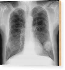Image result for lung cancer xray
