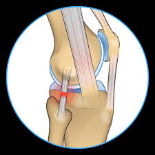 Some think that its presence (or reconstruction) may result in better outcomes from acl stabilization surgery 2. Knee Pain On The Outside Of Your Joint Five Reasons Why Spring Loaded Technology