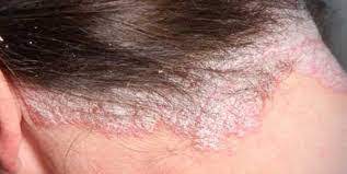 علاج الصدفية فروة الرأس في المنزل دليلك لزراعة الشعر
