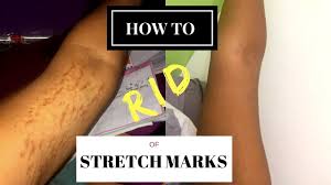 Removing stretch marks and doing it fast is one of the most asked question and for a good reason! How To Get Rid Of Stretch Marks Scars Fast Realwednesdays Youtube