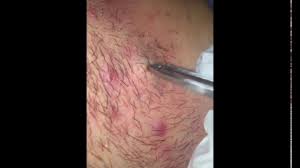 Ingrown hair on the neck. Gross Graphic Huge Ingrown Hairs Inside Neck Youtube Ingrown Hair On Neck Ingrown Hair Face Hair