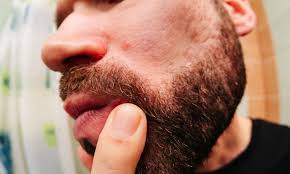 How to diminish brown spots on your face the cheap way. Ingrown Hairs In Your Beard Here S How To Treat Them Razors Co