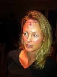 Although the percentage of cases in men is much lower than in women, male breast cancer accounts for a por. Skin Cancer Nodular Basal Cell Carcinoma Tumor On Face Post Op Photo Forehead French Word A Day