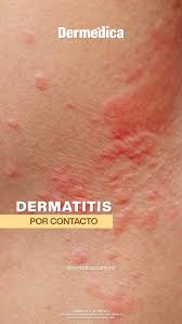 Image result for dermatitis contacta