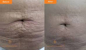 Treatment can make them fade, but they may never completely disappear. Stretch Marks Treatment