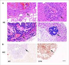 Like many of the other organs in your body, your liver is also susceptible to developing disease, which. Metastasis Of Prostate Cancer In P53 Pea A Rb Pea A Mice A Areas Of Download Scientific Diagram