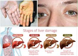 It is located beneath the rib cage in the right upper abdomen. 5 Liver Damage Red Flags That You Easily Ignored Liver Fatty Liver Digestion Process