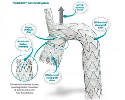 nexus arch branch stent graft system shows positive mid term