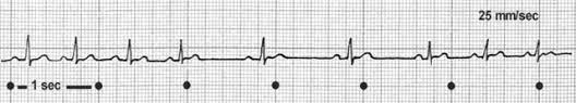 Sinusarrhythmie