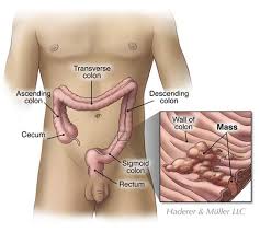 In the second example below, an em dash is more common than a colon, though the use of a colon is nevertheless correct. Patient Education Library Star Medical Associates