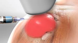 Image result for Shoulder Injection