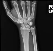 Image result for Hand Growth Plates