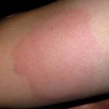 Itchy rash on arms or elsewhere should not be concerning if it resolves within a day or two. Skin Rash Causes 68 Pictures Of Symptoms And Treatments