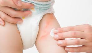 Image result for diaper dermatitis