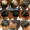 Best Hairstyles For Alopecia