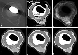 Maybe you would like to learn more about one of these? Cross Section Through The Proximal Femur A Original Ct B Manually Download Scientific Diagram