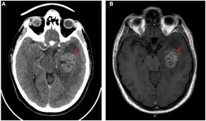 Glioblastoma Multiforme Concise Medical Knowledge
