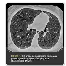 Ct Image Of Lam Lung Rare Disease Lunges How To Raise Money