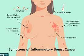 Common symptoms of breast cancer include: Inflammatory Breast Cancer Overview And More