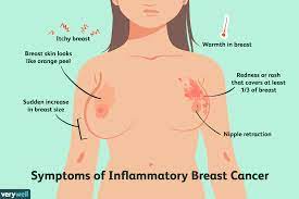 Pain in the breast skin changes in the breast area. Inflammatory Breast Cancer Overview And More