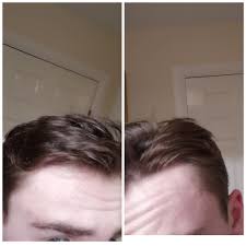 Thanks for the work you do! Is It Normal To Have An Uneven Hairline Like This My Left Temple Has Less Hair Than My Right Malehairadvice