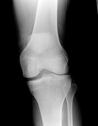 Image result for Knee XRay