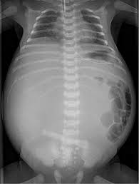 Image result for Intestinal Atresia