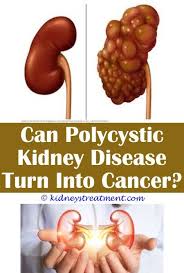 Kidney Stones Men Kidney Disease Kidney Disease Diet Kidney Disease Symptoms