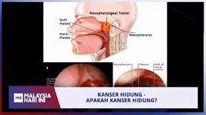 Kanser hidung ini terbahagi kepada dua jenis: Kanser Hidung Apakah Kanser Hidung Mhi 15 Ogos 2019 Youtube