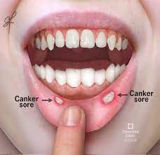 Canker Sore (Aphthous Ulcer): What It Is, Causes & Treatment