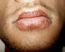 How To Get Rid Of Chapped Lips Fast: 5 Simple Tips - Bellatory