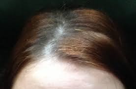 Hydrosulfite rapidly reduces the dye molecule itself, safely removing the coloring from your hair without the need for bleach, ammonia, or peroxide. Color Oops Extra Strength Hair Color Remover Reviews Makeupalley