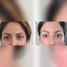 El Plasma Rico en Plaquetas...