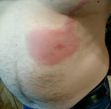 Recluse bites vary in severity from insignificant to very bad, requiring medical attention. Brown Recluse Spider Bite Sufficientself Creating A Sustainable Lifestyle