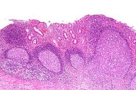 Diversion colitis is a condition where inflammation occurs in the part of the colon that is bypassed after ostomy what is diversion colitis? Diversion Colitis Libre Pathology