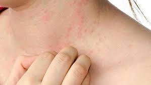 uyuz hastaligi hakkinda bilinmesi gerekenler iste belirtileri ve tedavisi saglik haberleri