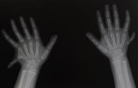 Image result for Polydactyly