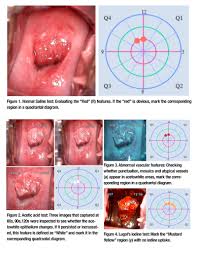 Image result for Colposcopy Findings