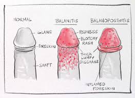 Image result for balanoposthitis