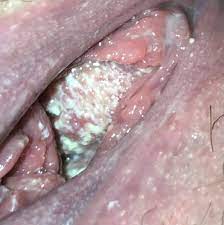 Check spelling or type a new query. Does This Look Like Bv Bacterial Vaginosis Forums Patient