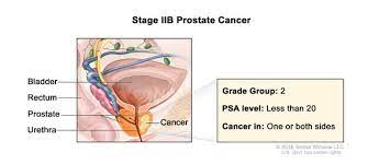 stage iv prostate cancer prognosis. Definition Of Stage Ii Prostate Cancer Nci Dictionary Of Cancer Terms National Cancer Institute