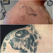 Check spelling or type a new query. Home Evolve Tattoo Removal