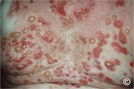 Image result for Pemphigoid