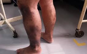 Image result for Stasis Dermatitis