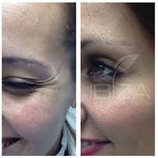 Su nombre real es toxina botulínica la que es un medicamento que se formula a partir del cultivo de un microorganismo, el clostridium botulinum, algo similar a como se preparan las vacunas. Precio De Botox Cual Es El Precio 130 Zona Facial